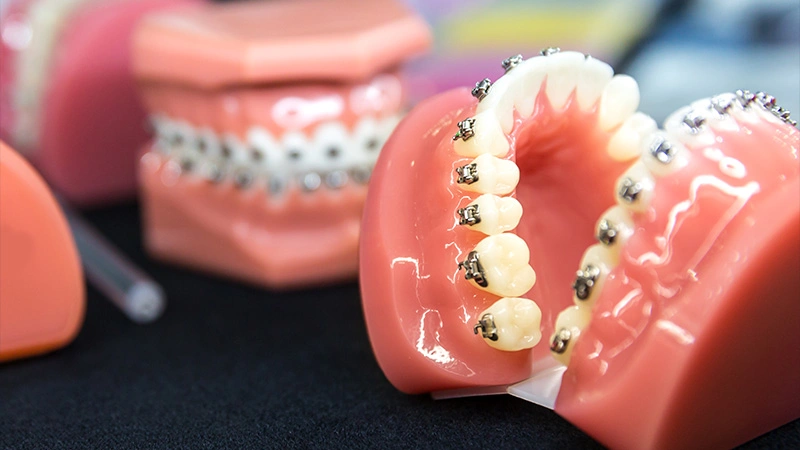 When braces or aligners are the safer choice